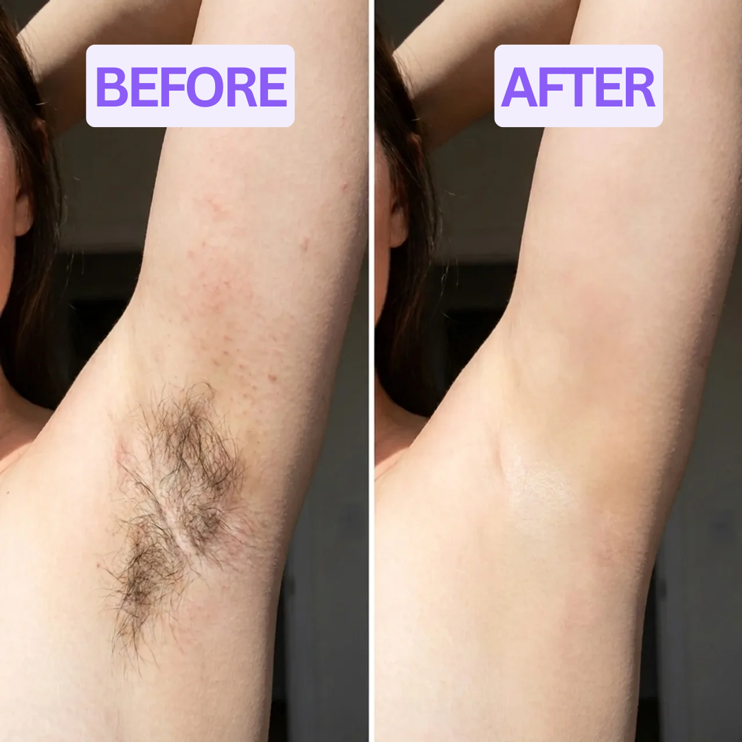 AquaSkin™ Hair Removal